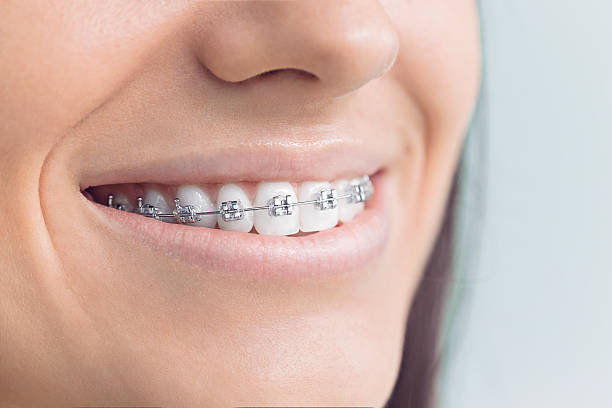 Dental Bonding in Millsboro, DE